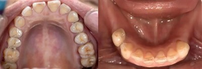 Digital Precision Restoration with Aident3D: Successful Removable Partial Den...