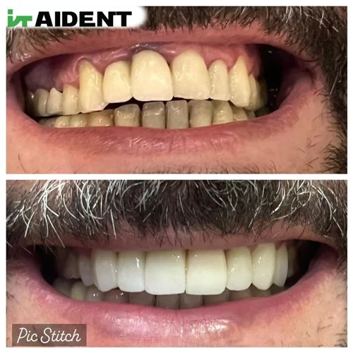 Feedback From Lebanon Regarding Intraoral Scanners