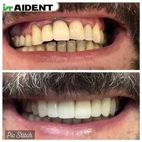 Real Feedback From A Vietnam Dentist On The Final Fitting Of A Dental Restoration Using The AIDEN...